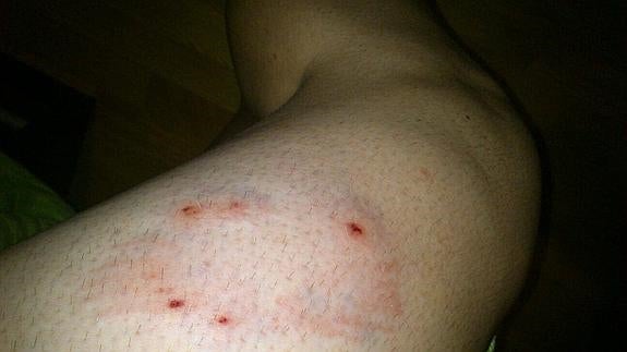 Mordedura sufrida por el corredor en una pierna. 