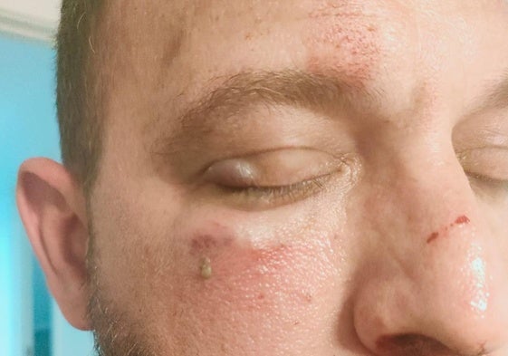 Fractura de mandíbula, lesiones y amenazas: un detenido por agredir a un guardia civil fuera de servicio en Roquetas