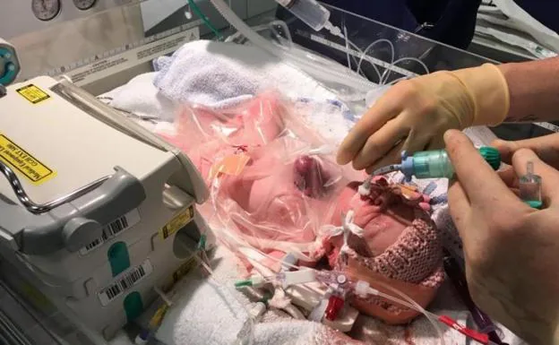 El increíble nacimiento de un bebé con el corazón fuera del pecho