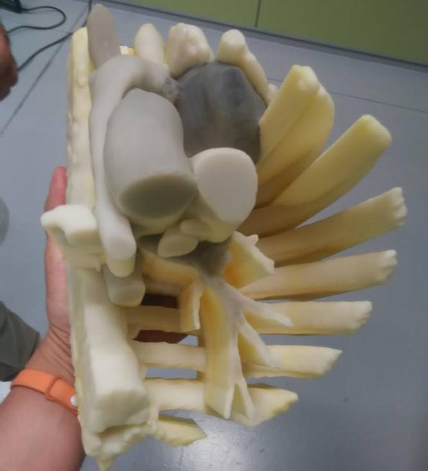Fabrican en Martos un modelo en 3D para facilitar la operación del tumor en el pecho de una niña