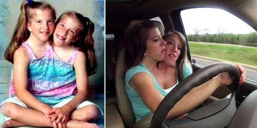 Brittany y Abby Hensel son del estado norteamericano de Minessota y guardan una historia peculiar