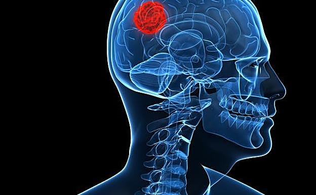 La maravilla de la Medicina: operar un tumor cerebral con la voz y los gestos