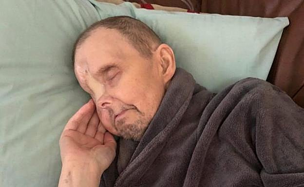 Se queda con un gran agujero en la cara porque los médicos confundieron su cáncer ocular severo con migrañas