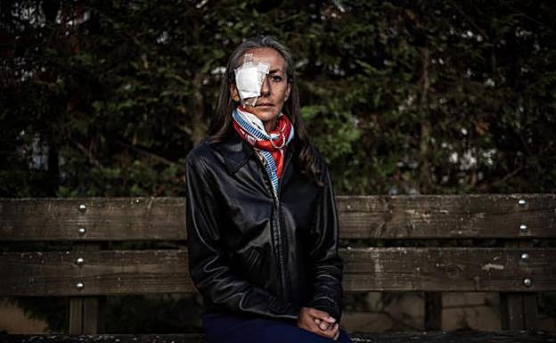 Corine Remande, la mujer que ha perdido la visión en su ojo derecho. 