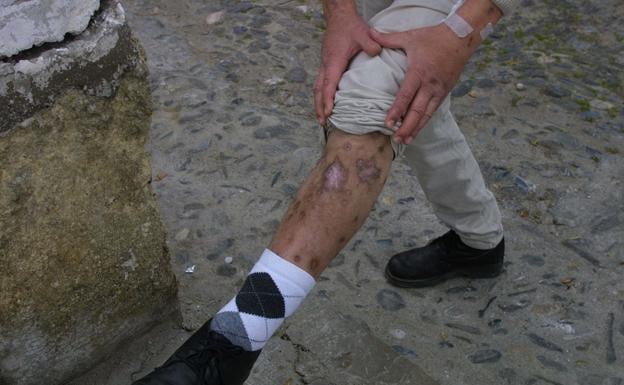 Año 2003. Un heroinómano enseña sus piernas, completamente cubiertas de heridas por las inyecciones de heroína.
