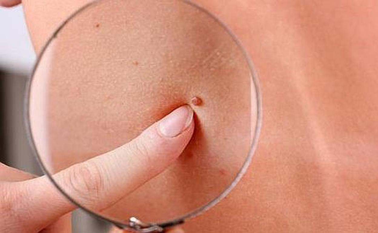 Melanoma: los daños del sol en la piel provocan una muerte cada 9 minutos