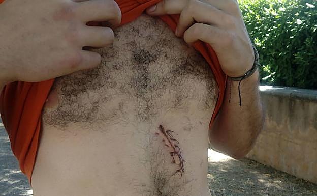 J. G. muestra su herida, por la que tuvo que pasar por quirófano.