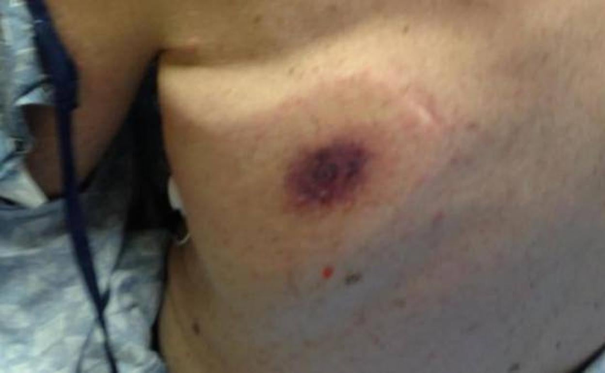 Muerto por una bacteria 'comecarne': así fue como le mordió en la playa