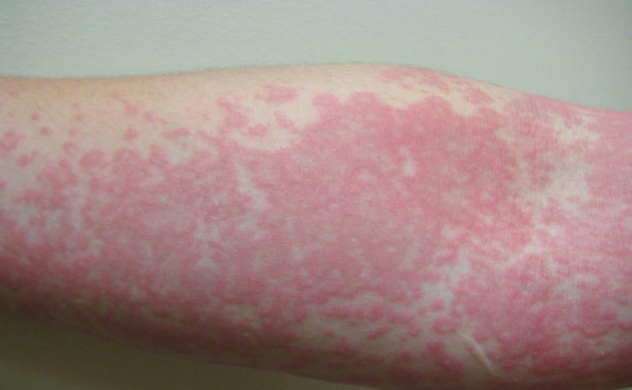 Efectos del coronavirus en la piel.