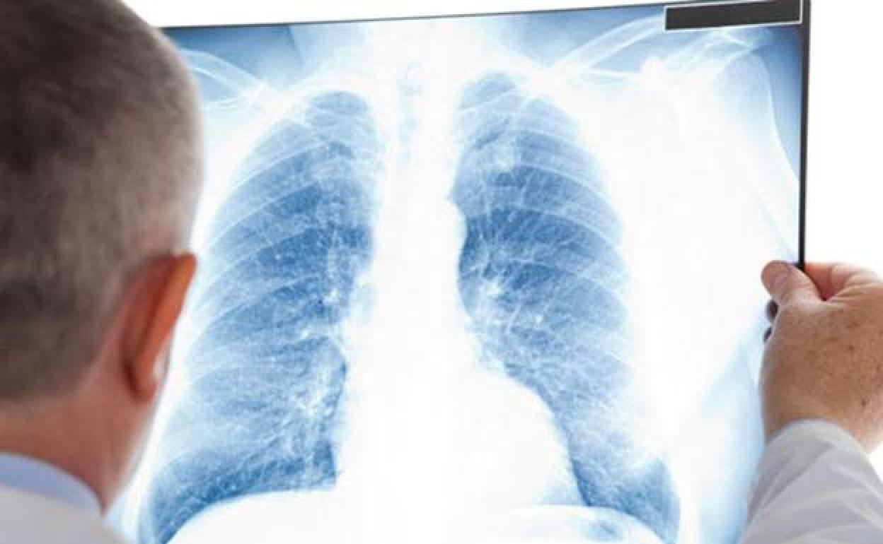 Secuelas de la Covid | Un estudio desvela el daño a largo plazo que el coronavirus hace a los pulmones