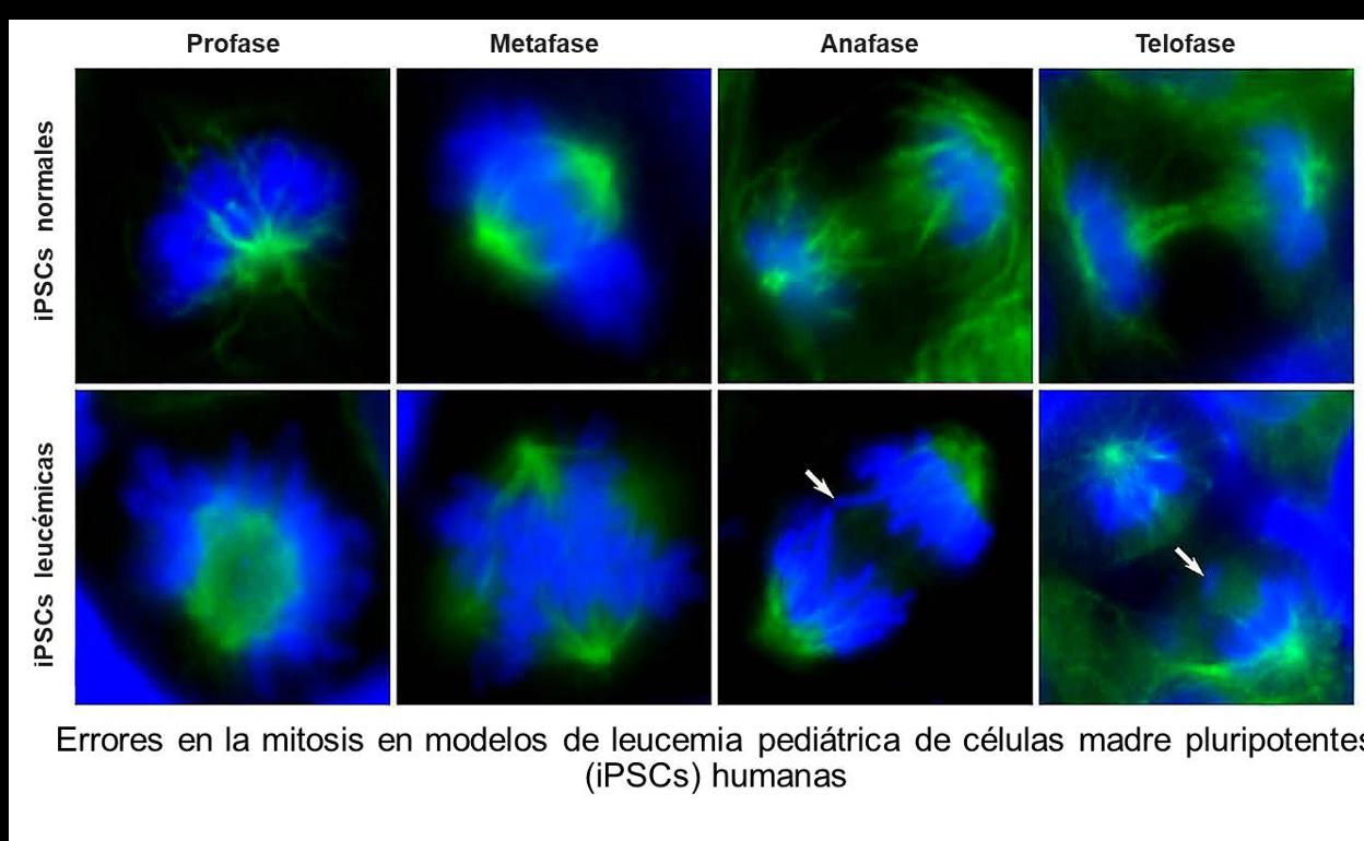 Una donación permite el impulso de una investigación sobre las células madre cancerígenas implicadas en la leucemia infantil