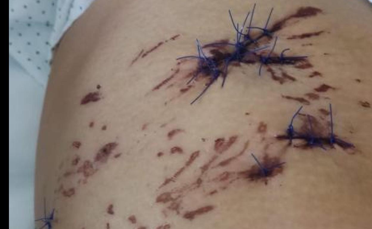 La mujer atacada por los perros en Armilla. 