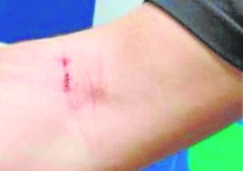 El brazo del agente, tras recibir el golpe con el bate de béisbol.