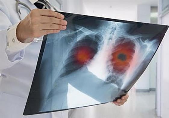 Los nuevos casos de cáncer de pulmón suben un 15% en Jaén