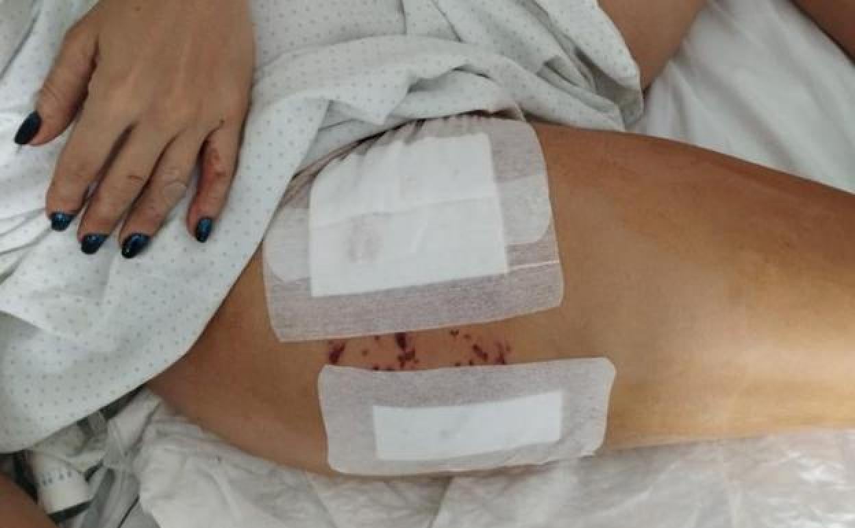 Las heridas provocadas por los perros a esta vecina de Armilla . 