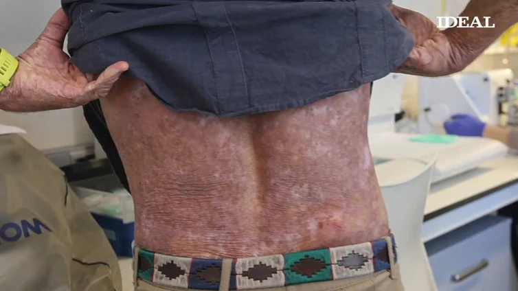 Prueban con éxito un trasplante de piel artificial creada en la UGR