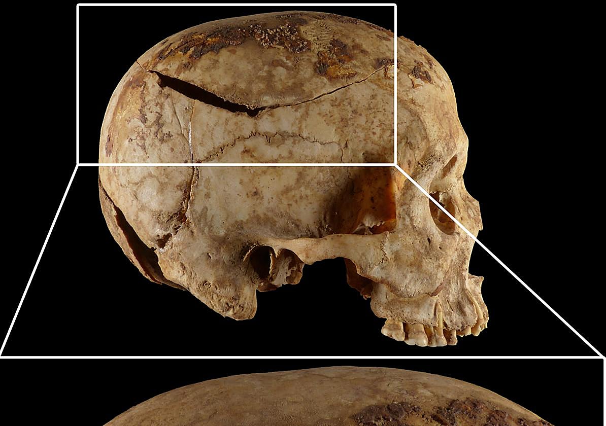 Calavera de una de las víctimas