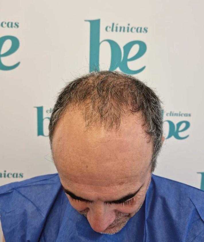 Imagen secundaria 2 - Recupera tu cabello con la técnica más avanzada en Clínica Be, centro de referencia