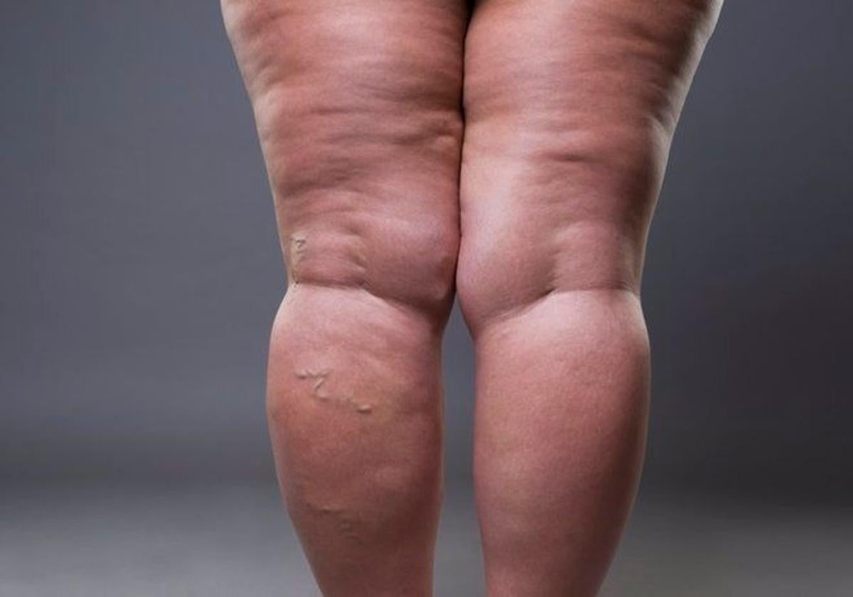 ¿qué es el lipedema? Los síntomas que alertan de la enfermedad | ideal