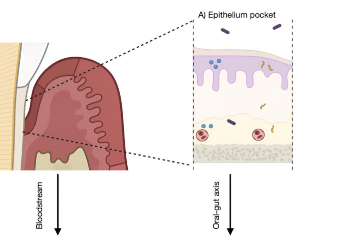 La periodontitis favorece el cáncer colorrectal al liberar CEA e IL-6 en la sangre y diseminar bacterias como Fusobacterium nucleatum, lo que altera la microbiota intestinal, reduce las defensas antitumorales y crea un ambiente proinflamatorio que promueve tumores.