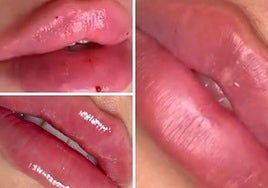 Ejemplos de aumentos de labios llevados a cabo en la clínica.