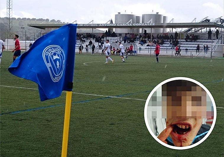 Una pelea multitudinaria en un partido entre el Íllora y el Puerto de Motril deja cuatro heridos, uno con la mandíbula rota