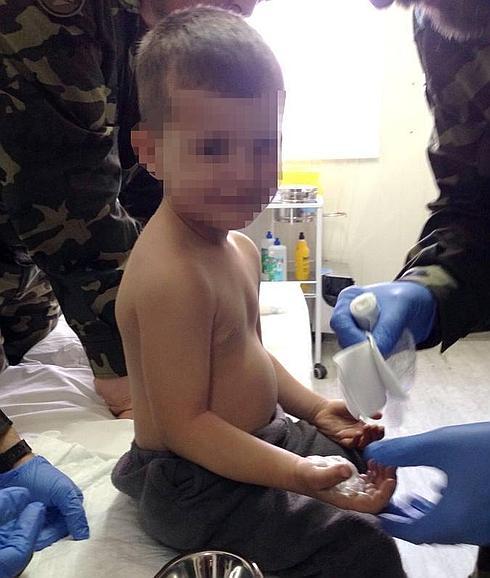 Niño con quemaduras. 