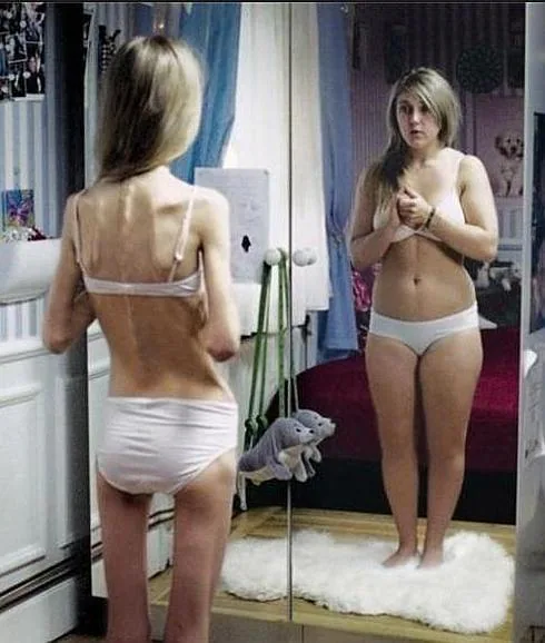 En España puede haber 400.000 mujeres con anorexia nerviosa, cada vez más común en adolescentes