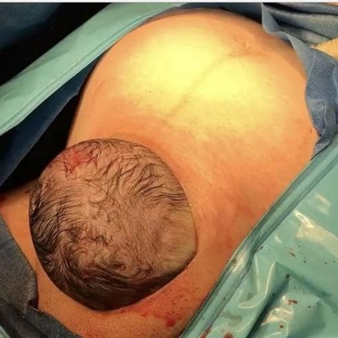 Impactantes imágenes de un bebé naciendo por sí sólo del vientre de su madre