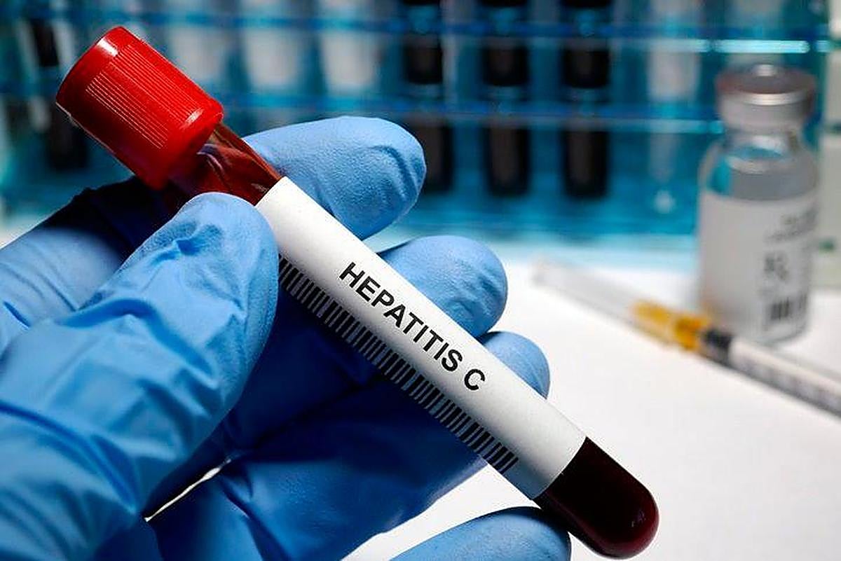La hepatitis es una inflamación del hígado causada por una infección vírica.