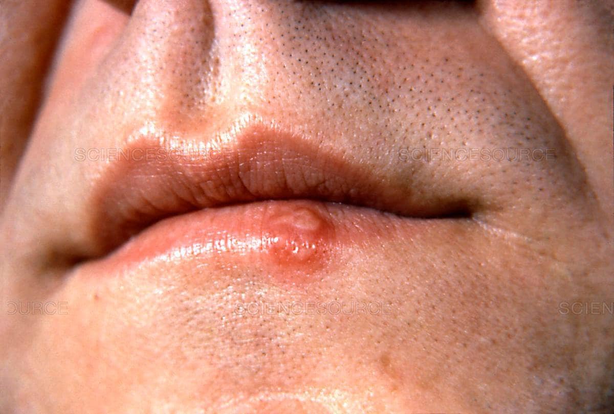 ¿Por qué sale el herpes labial y cómo se cura?