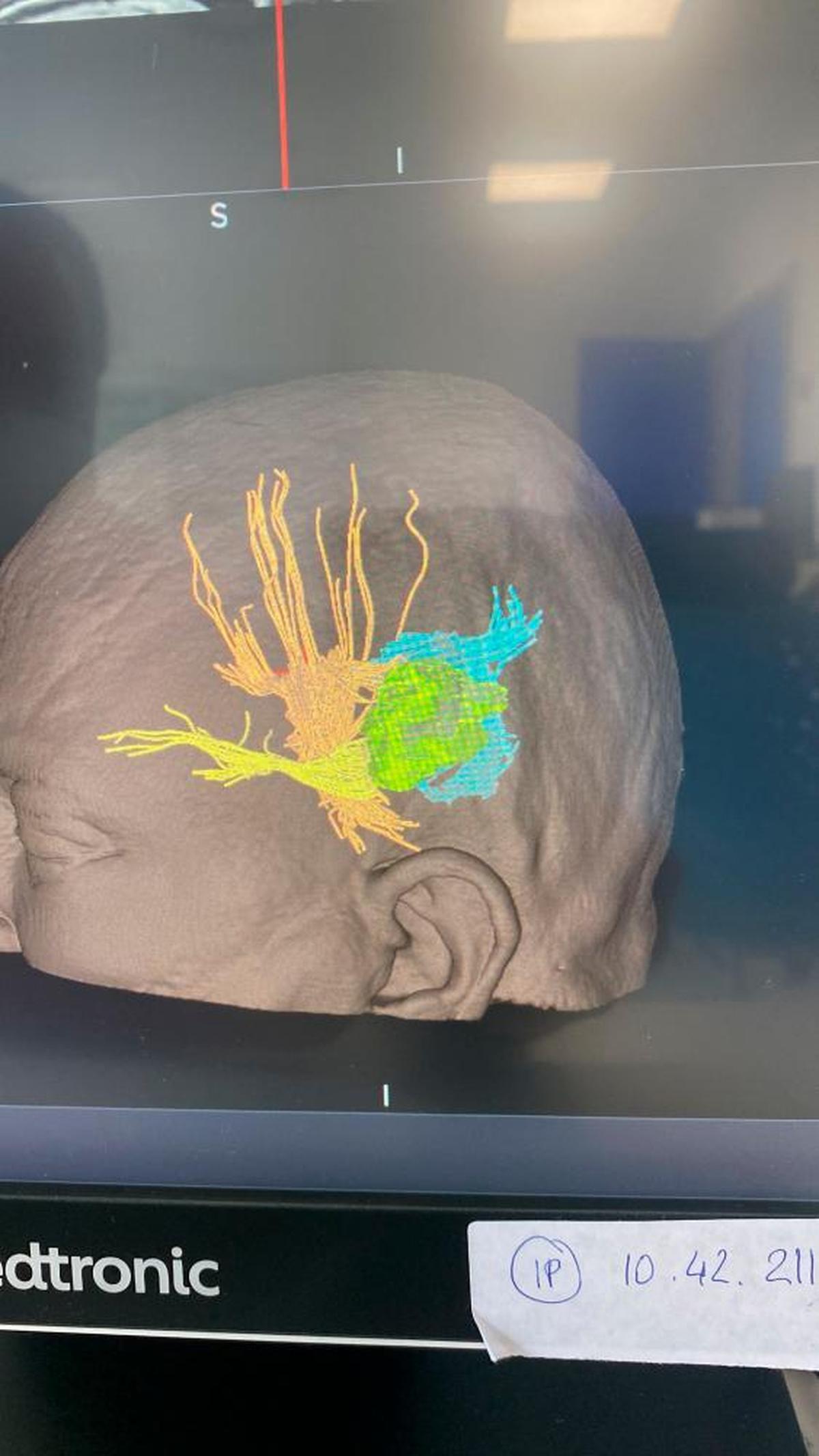 Estudio de un paciente para diferenciar el tumor de otras zonas.