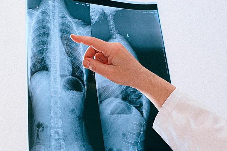 En total se han analizado 1.067 casos de cáncer de pulmón.