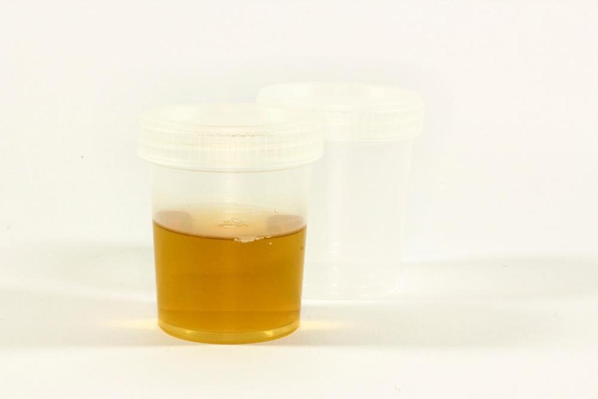 La pielonefritis aguda suele aparecer como una complicación en la evolución de una infección urinaria banal.