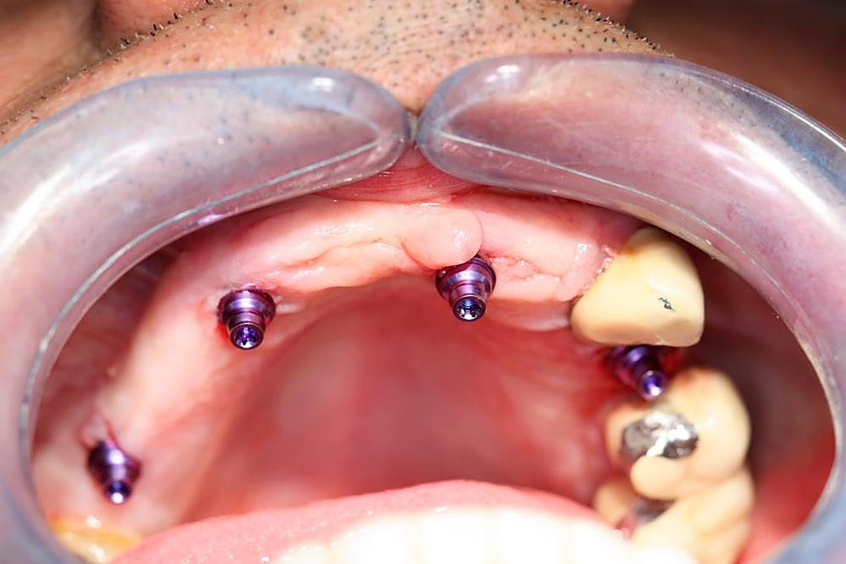 PASO 6. El paciente, con los dispositivos del implante colocados.
