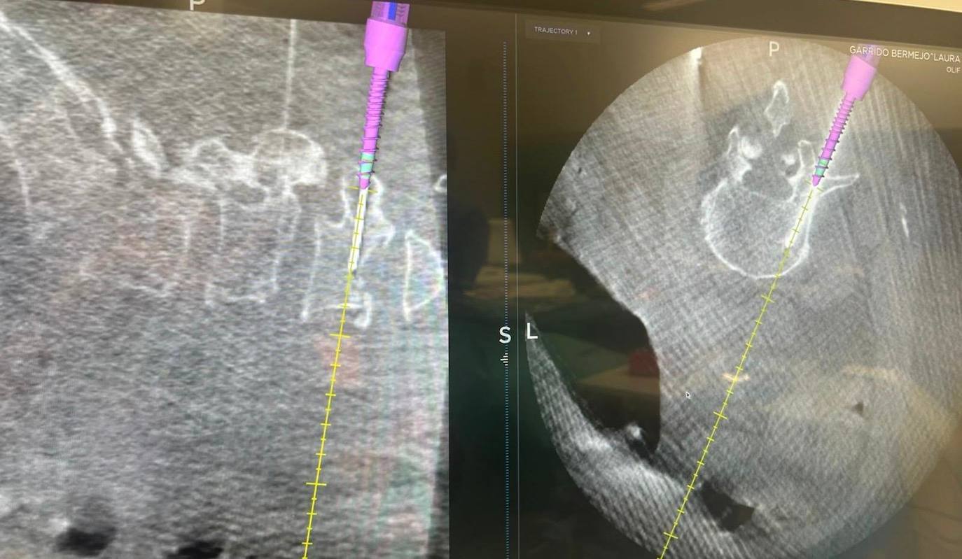 Imagen secundaria 2 - El Hospital da un &#039;giro&#039; a la cirugía de columna y la opera por el abdomen