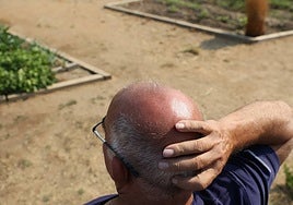 Un hombre con alopecia se lleva la mano a la cabeza.
