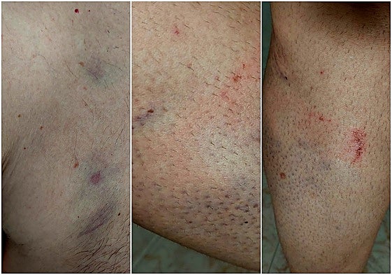 Imágenes de las heridas sufridas por los funcionarios del centro penitenciario de Topas.