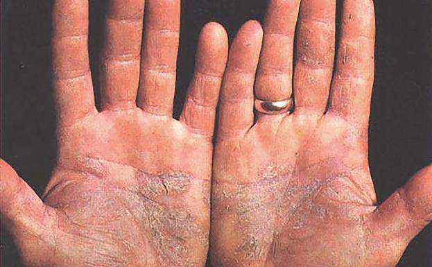 Un tercio de los casos de psoriasis se produce antes de los 20 años