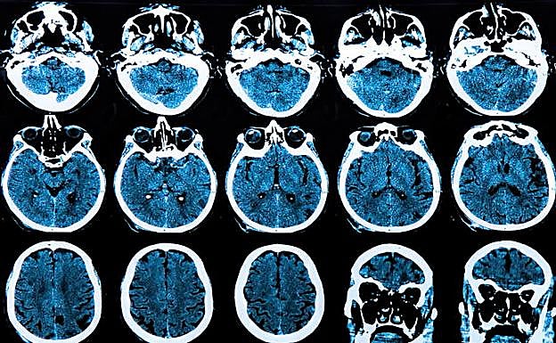 Escaner cerebral de un paciente.