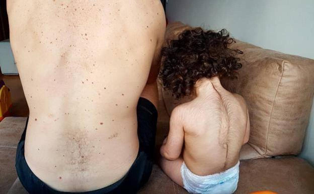 Foto enviada por una familia de Colindres al Defensor del Paciente, donde se aprecia el vello en la espalda de la niña de 26 meses, al lado de su padre, uno de los diez casos detectados en Cantabria. . 