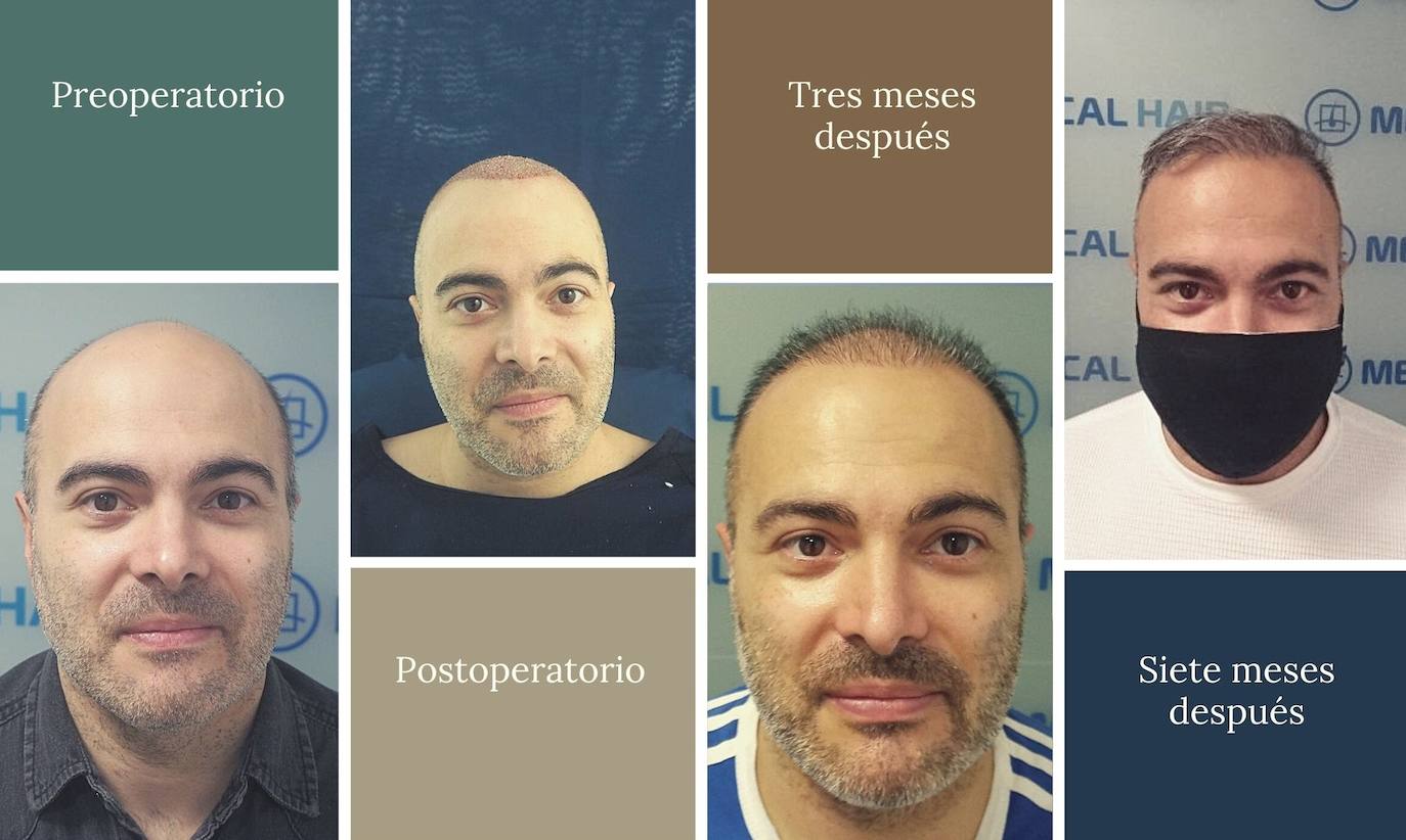 Ejemplo del proceso de microinjerto en Jesús