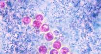 Criptosporidiosis