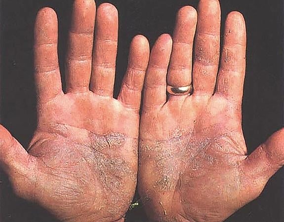 Fototerapia y una mejor nutrición, herramientas contra la psoriasis