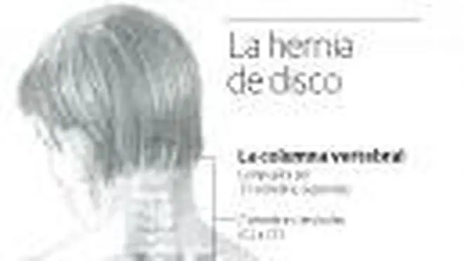 ¿Hay que operar una hernia de disco?