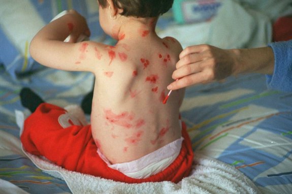 Una niña recibe tratamiento para las erupciones causadas por la varicela. :: ramón l. pérez