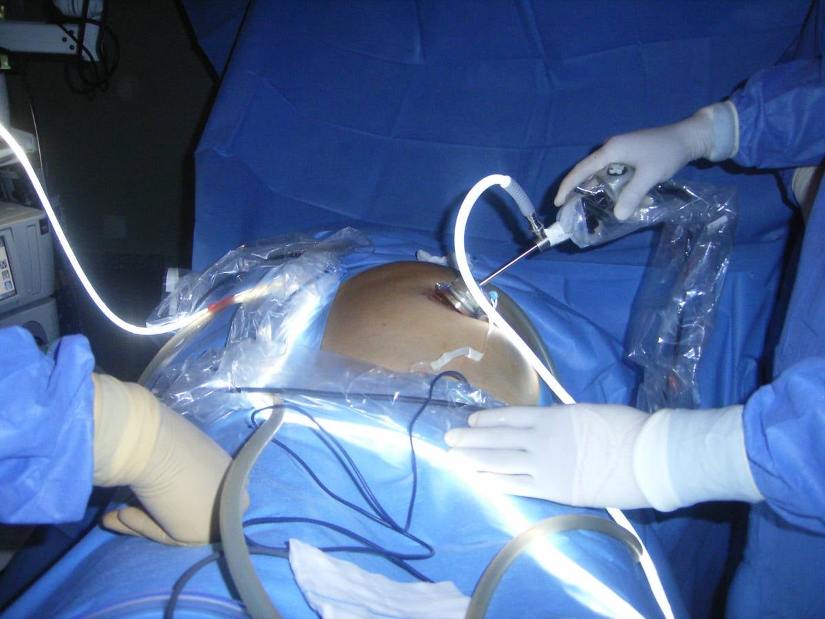 Cirugía laparoscópica en el tratamiento de un cáncer de colon. 