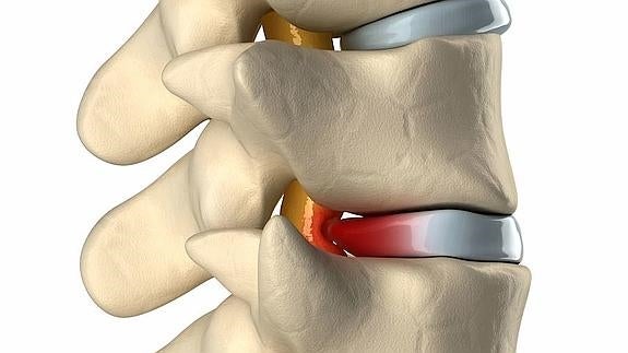 Representación gráfica de una hernia de disco. 