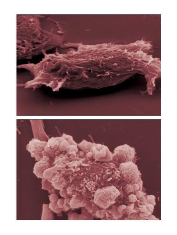 Composición de imágenes microscópicas de células cancerígenas del melanoma. :: efe