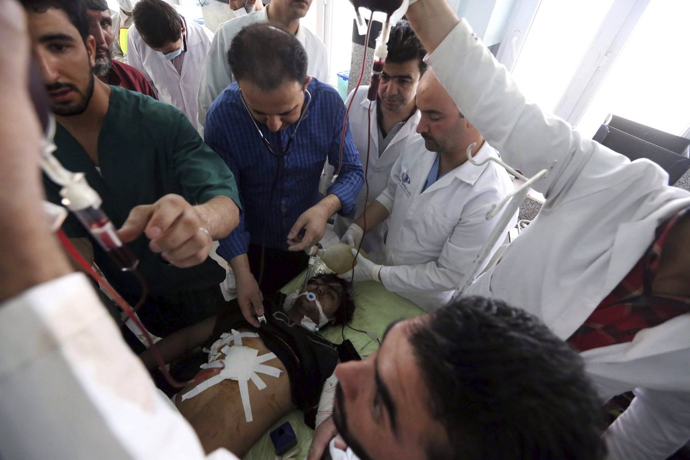 Un afgano, herido en una explosión, recibe tratamiento médico en un hospital de Herat (Afganistán) hoy, 30 de julio de 2016. Según fuentes oficiales, al menos una persona ha muerto y otras cinco resultaron heridas en la detonación de un artefacto. Se ha incrementado la inseguridad en Afganistán en medio de los enfrentamientos de las tropas gubernamentales con grupos opositores armados en varias partes del país. EFE/Jalil Rezayee